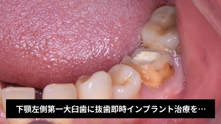 下顎左側第一大臼歯に抜歯即時インプラント治療を行なった症例 | マイ