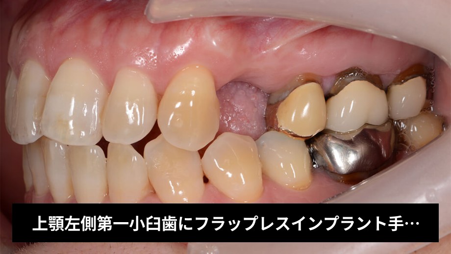 上顎左側第一小臼歯にフラップレスインプラント手術で即時修復治療を