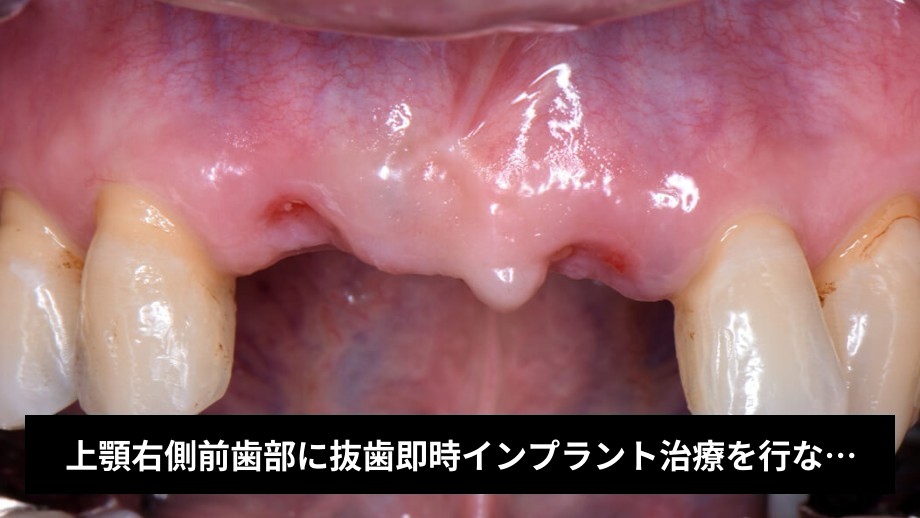 上顎右側前歯部に抜歯即時インプラント治療を行なった症例 | マイ