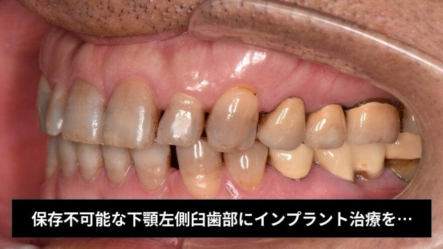 保存不可能な下顎左側臼歯部にインプラント治療を行った症例