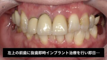 左上の前歯に抜歯即時インプラント治療を行い即日に仮歯までセットした症例