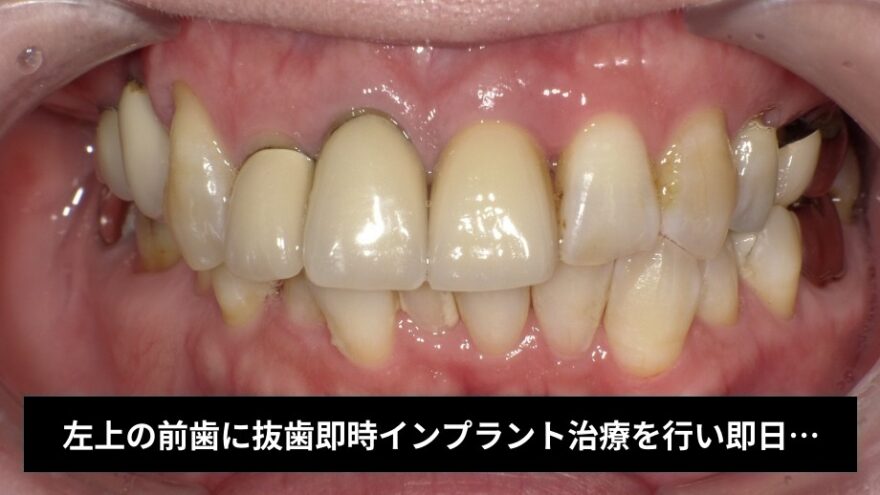 左上の前歯に抜歯即時インプラント治療を行い即日に仮歯までセットした症例