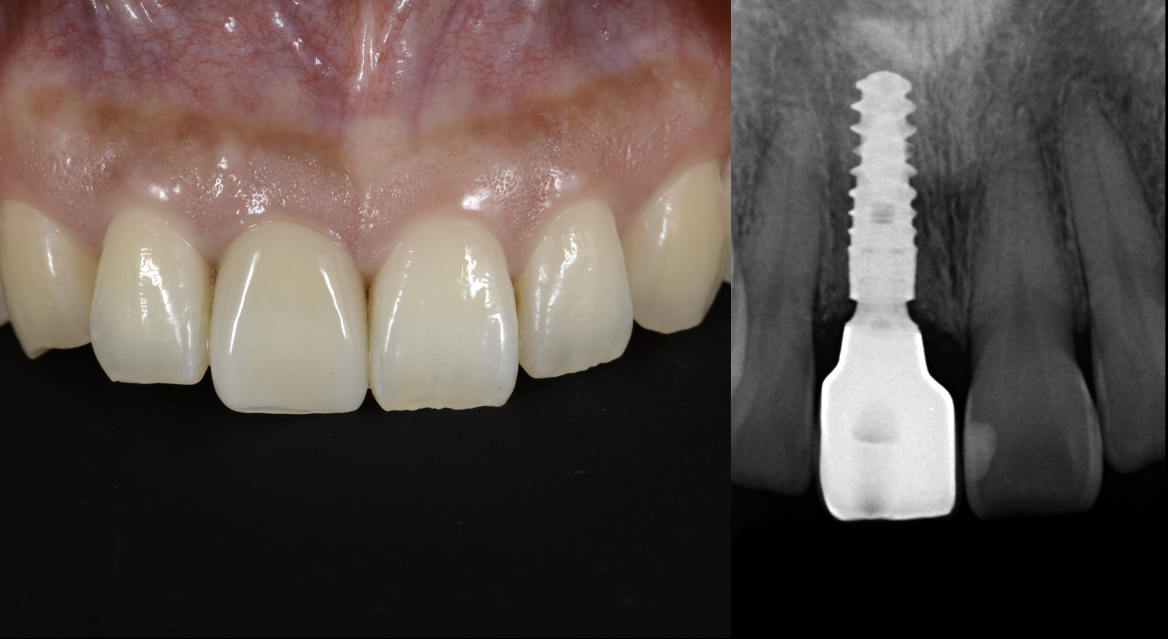 究極のインプラント審美 : 長期症例から学ぶ臨床テクニック　歯科 cf4088e1175c6202a029de8f07459d